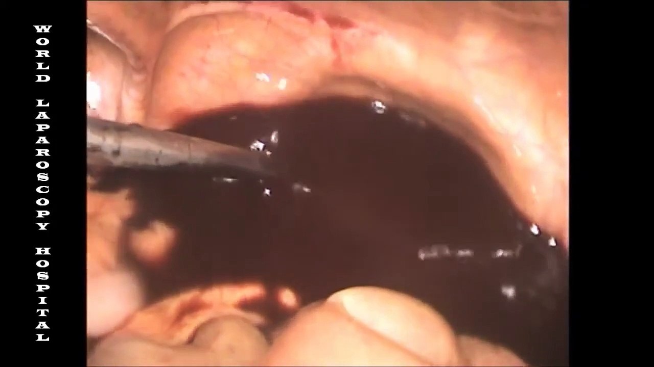 Diagnostic Laparoscopy by Dr. R.K. Mishra at World Laparoscopy Hospital