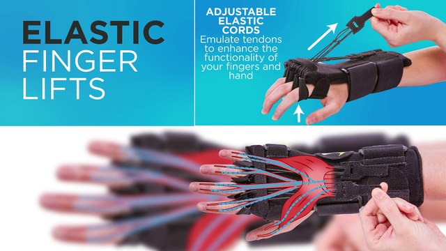 Radial Nerve Palsy Splint | Dynamic Wrist Drop & Finger Extension Brace