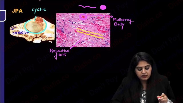 brain tumors // CNS PATHOLOGY