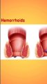 बवासीर, फिशर, भगन्दर में क्या अंतर है ? Difference between Piles, fissure and fistula in hindi ?