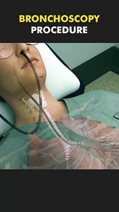 Bronchoscopy Procedure For Lung Biopsy 3D Animation
