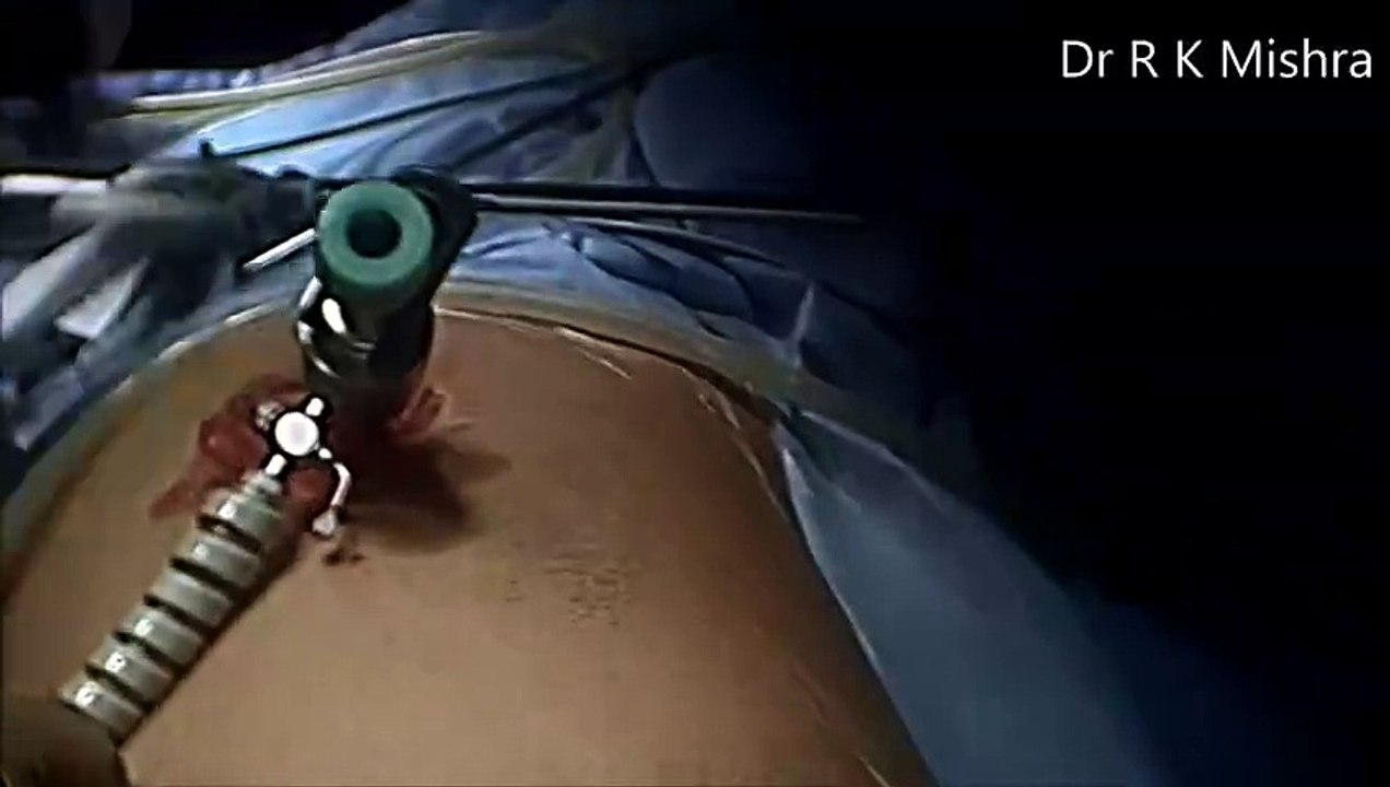 Diagnostic Laparoscopy Ovarian Drilling for PCOD and Tubal Patency Test