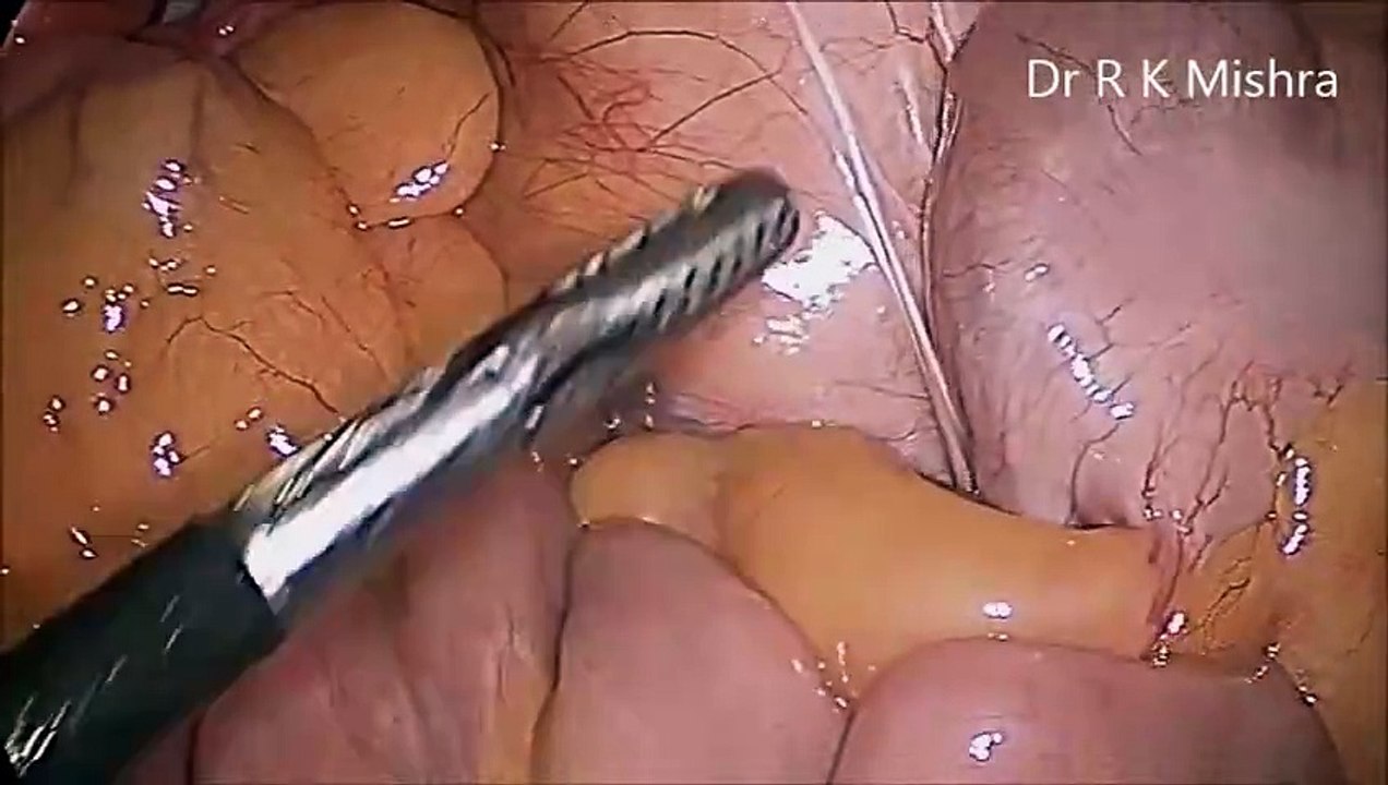 Diagnostic Laparoscopy Tubal Patency Test and Ovarian Drilling