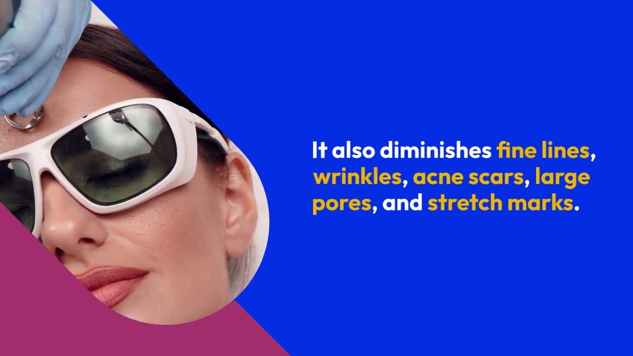 Benefits of Fraxel Laser Treatment