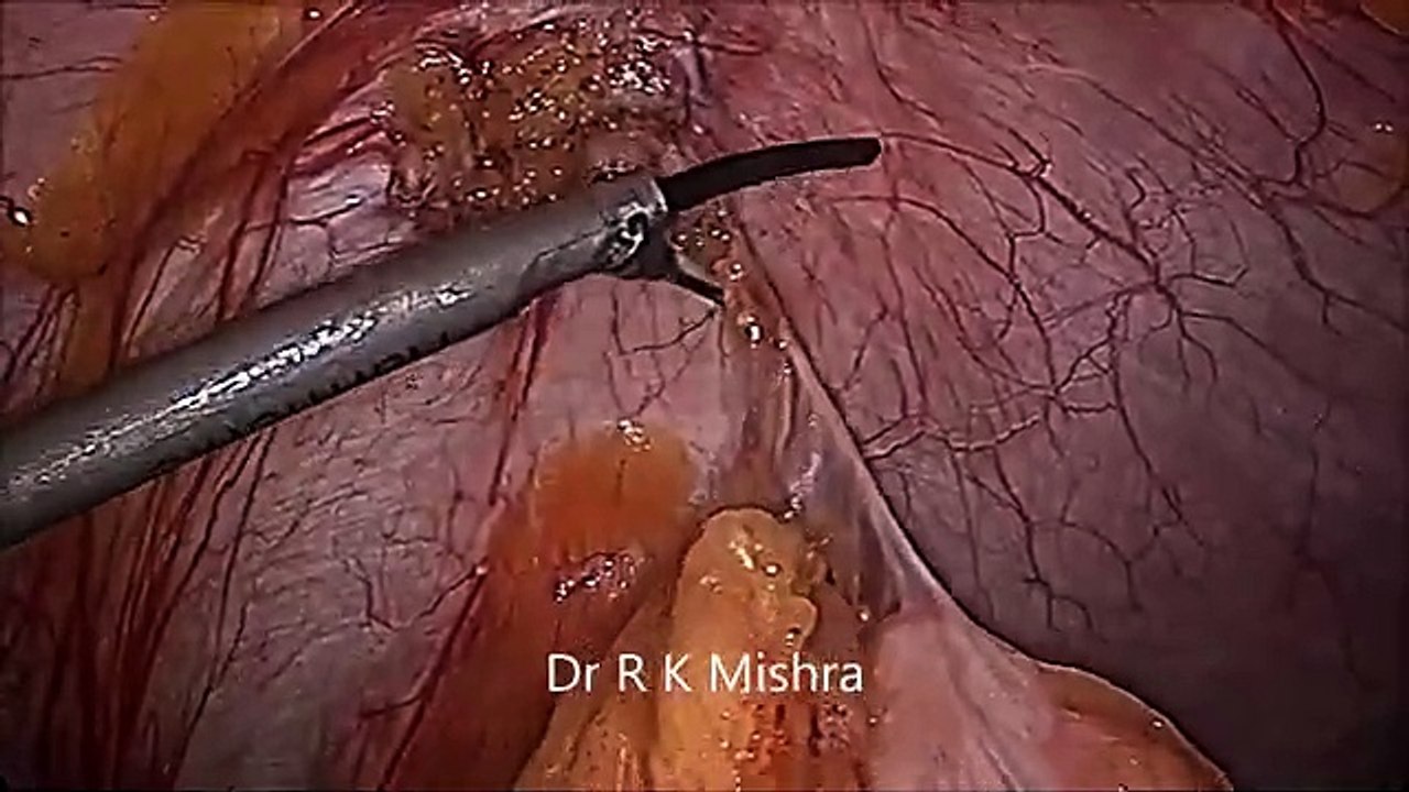 Laparoscopic Management of Bladder Endometrioma