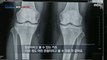 [HOT] Correlation between running and knee arthritis, MBC 다큐프라임 240421