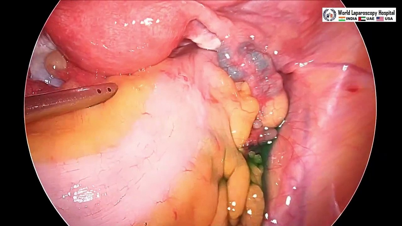 Diagnostic Laparoscopy Tubal Patency Test by ICG and Ovarian Drilling
