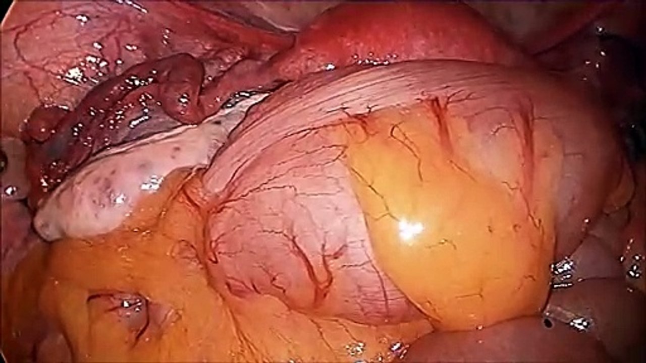 Diagnostic Laparoscopy Tubal Patency Test