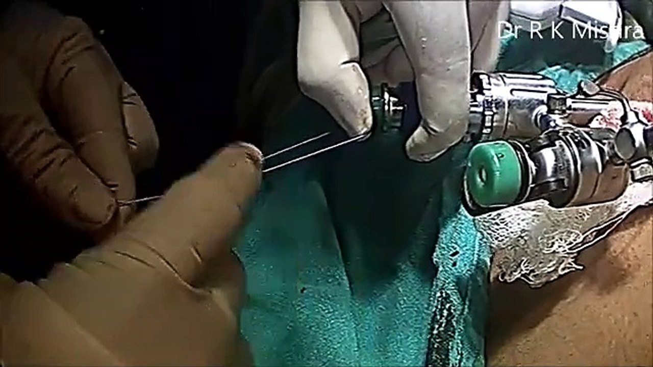 Laparoscopic Surgery for Pedunculated Myoma by Mishra s Knot