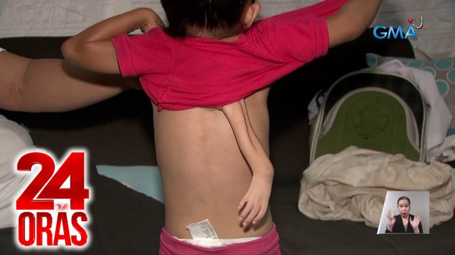 Batang may braso at kamay sa likod, na-operahan na sa tulong ng GMA Kapuso Foundation | 24 Oras