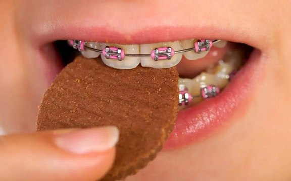 Ortodontista alerta pacientes para alimentos contraindicados para quem usa aparelho ortodôntico
