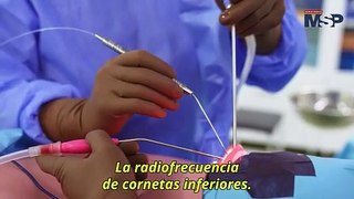 ¿Cómo funciona la cirugía de radiofrecuencia de cornetes para rinitis?