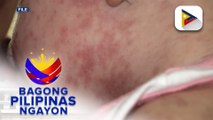 DOH, patuloy ang paalala sa mga magulang na pabakunahan ang anak vs. tigdas at pertussis