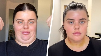 "I spent £2k removing my double chin - it went from saggy to snatched overnight"