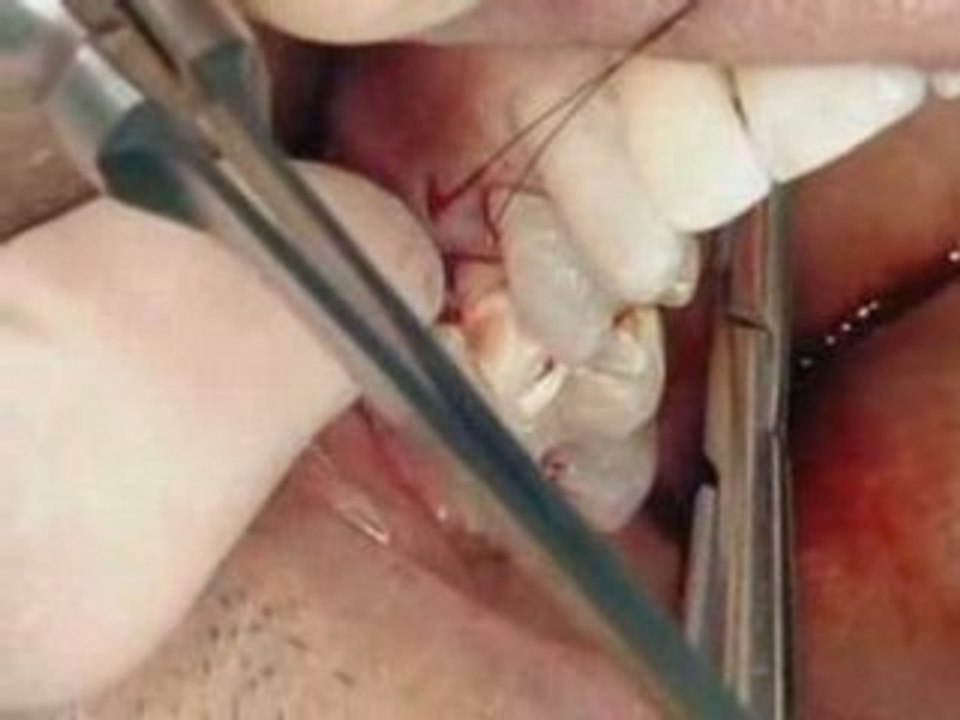 Emdogain Plus (Strauman) : protocole clinique (vidéo)