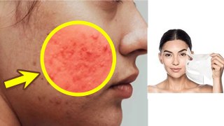 Facial Mask Lagane Ke Baad Acne Kyu Aate Hai|Pimples After Using Face Mask Reason...|Boldsky