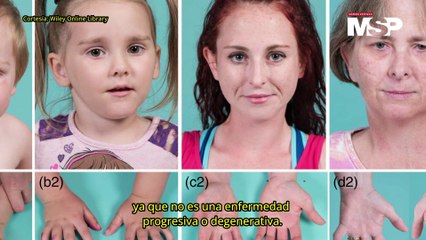 ¿Qué es la Artrogriposis Múltiple Congénita y Cómo Afecta a los Pacientes? 🤔