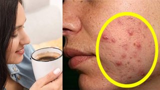 Coffee Peene Se Pimple Hote Hain Kya | Does Drinking Coffee Cause Acne | Boldsky