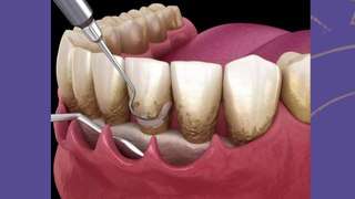 bd-dientes-flojos-y-posibles-soluciones-010524