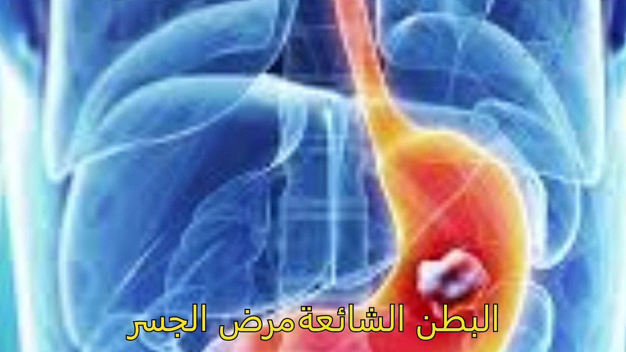 غازات المعدة قرحة المعدة الحموضة سرطان المعدة قرحة المعدة أفضل علاج لجميع هذه الأمراض