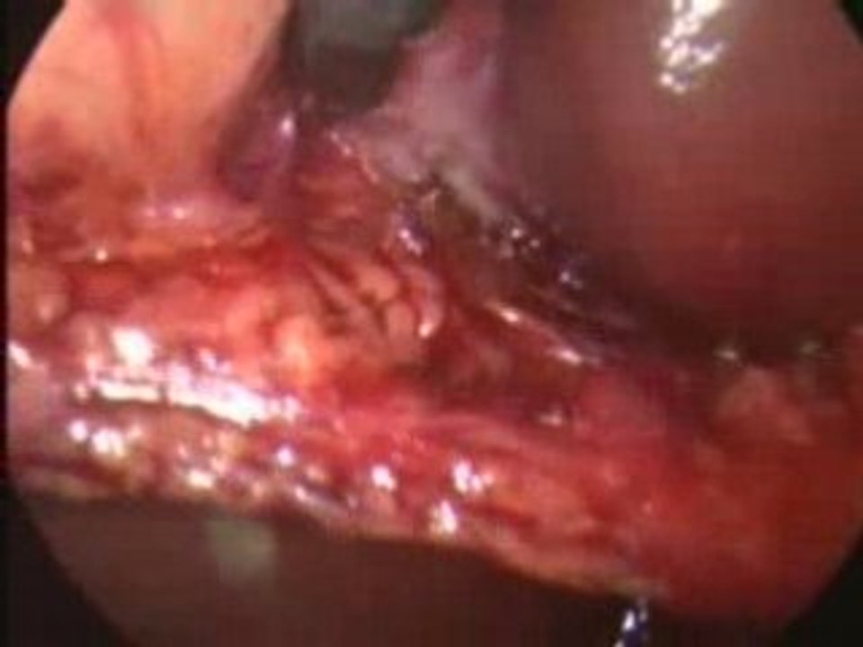 Laparoscopic cholecstectomy (SOS cystic artery)