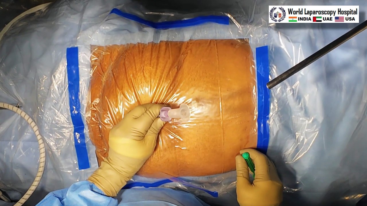 Laparoscopic Removal of paraovarian cyst also known as a paratubal cyst and Appendix