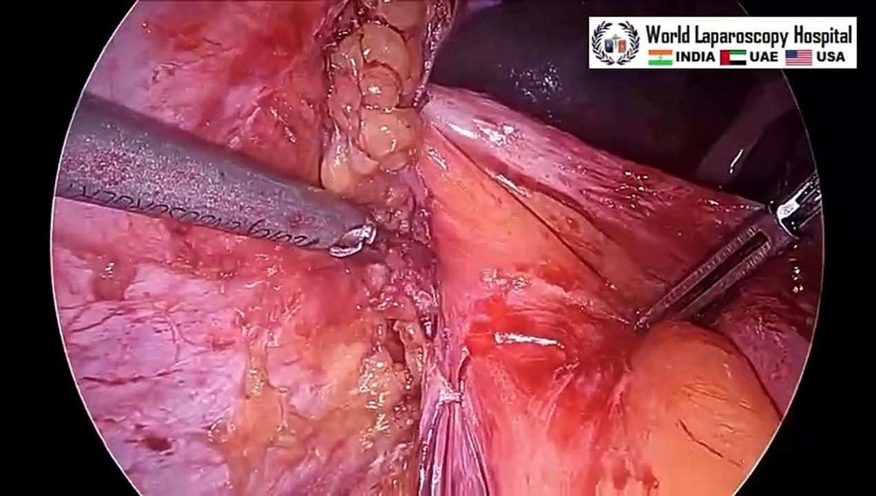 Laparoscopic Repair of Recurrent Incisional Hernia Emphasizing Timesh and Mishras Knots