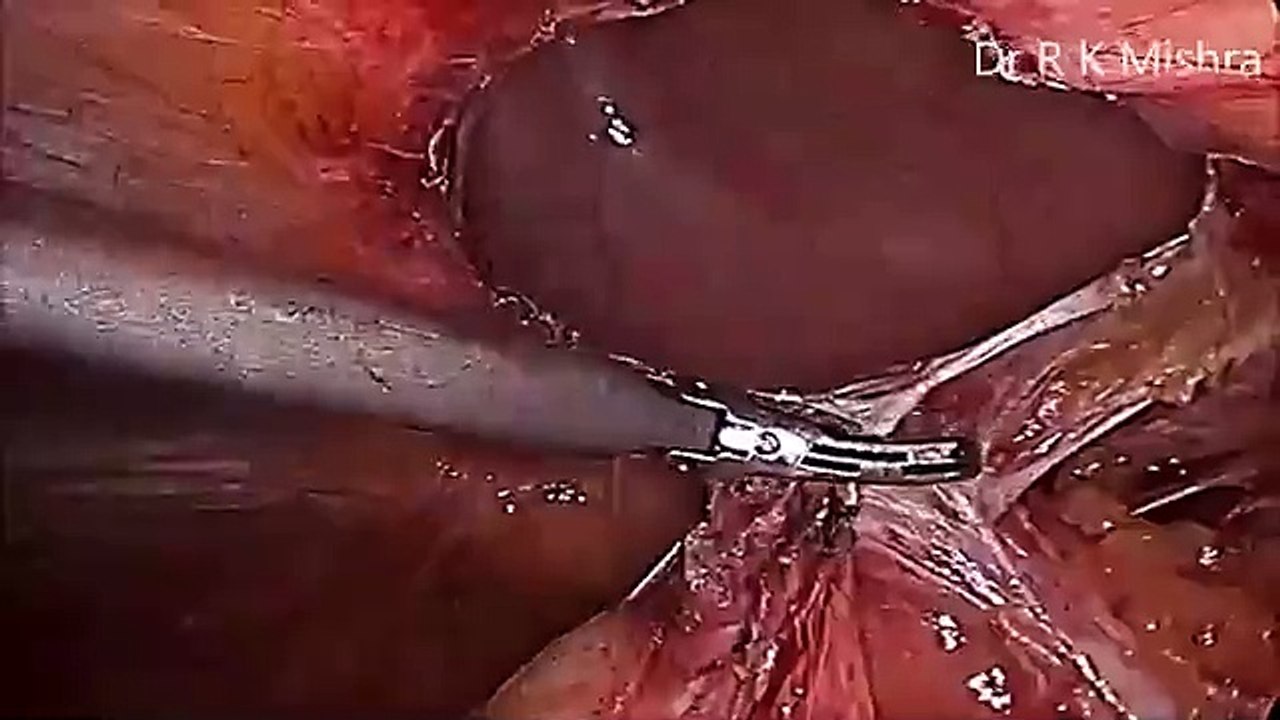 Laparoscopic Repair of Epigastric Hernia by Two Ports