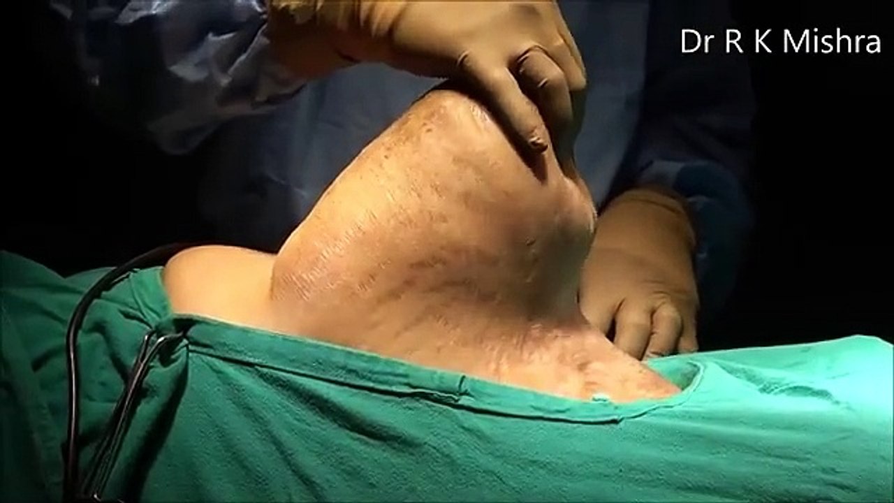 Laparoscopic Repair of Huge Incisional Hernia