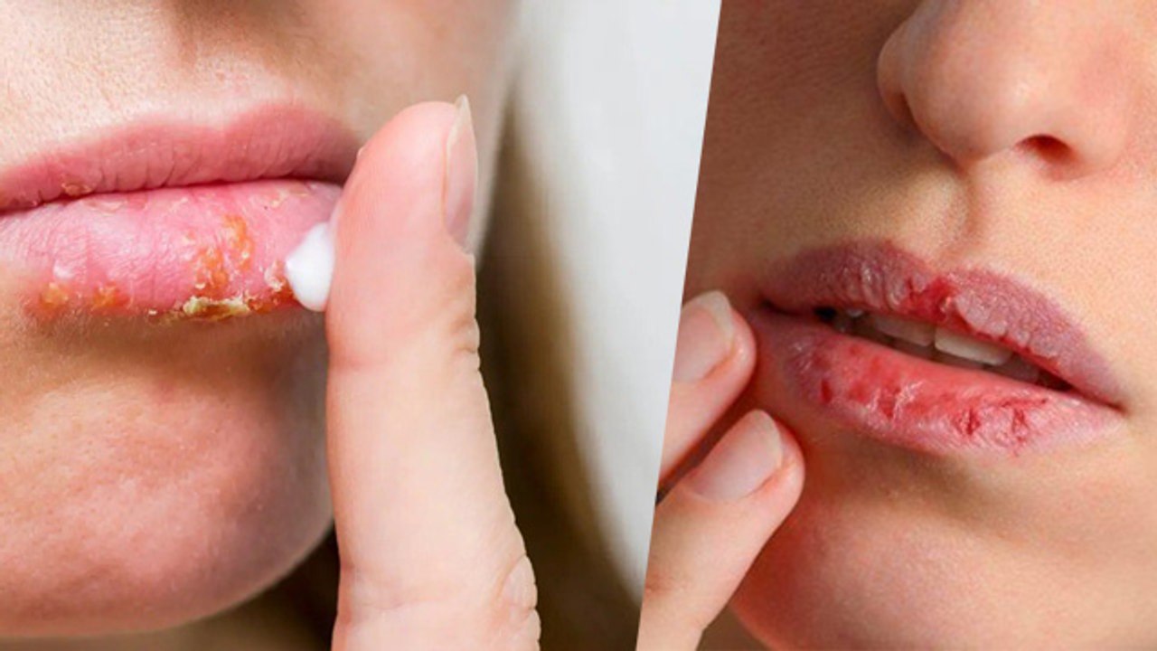 गर्मियों में होंठ क्यों फटते है | Garmi Me Fate Hoto Ka Ilaj | Dry Lips ...