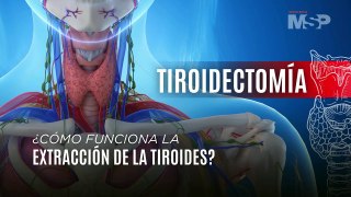 Tiroidectomía: ¿Cómo funciona la extracción de la tiroides? - #EspecialMSP