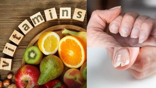 Kis Vitamin Ki Kmi Se Nakhun Khrab Hote Hai|Vitamin Deficiency Symptoms In Nails|Boldsky
