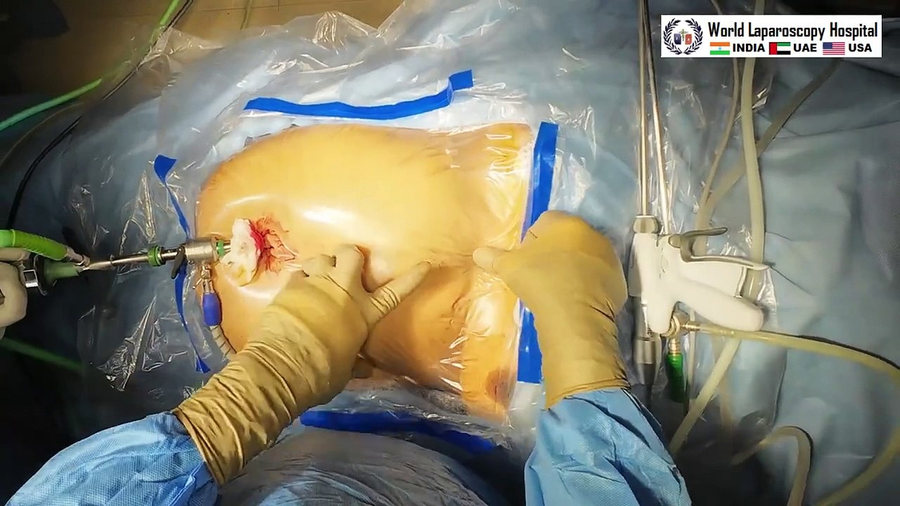 Laparoscopic Cholecystectomy and  Appendectomy through the same port using Mishra's Knot and ICG