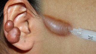 Ear Keloid Reason In Hindi, Treatment क्या है | Boldsky