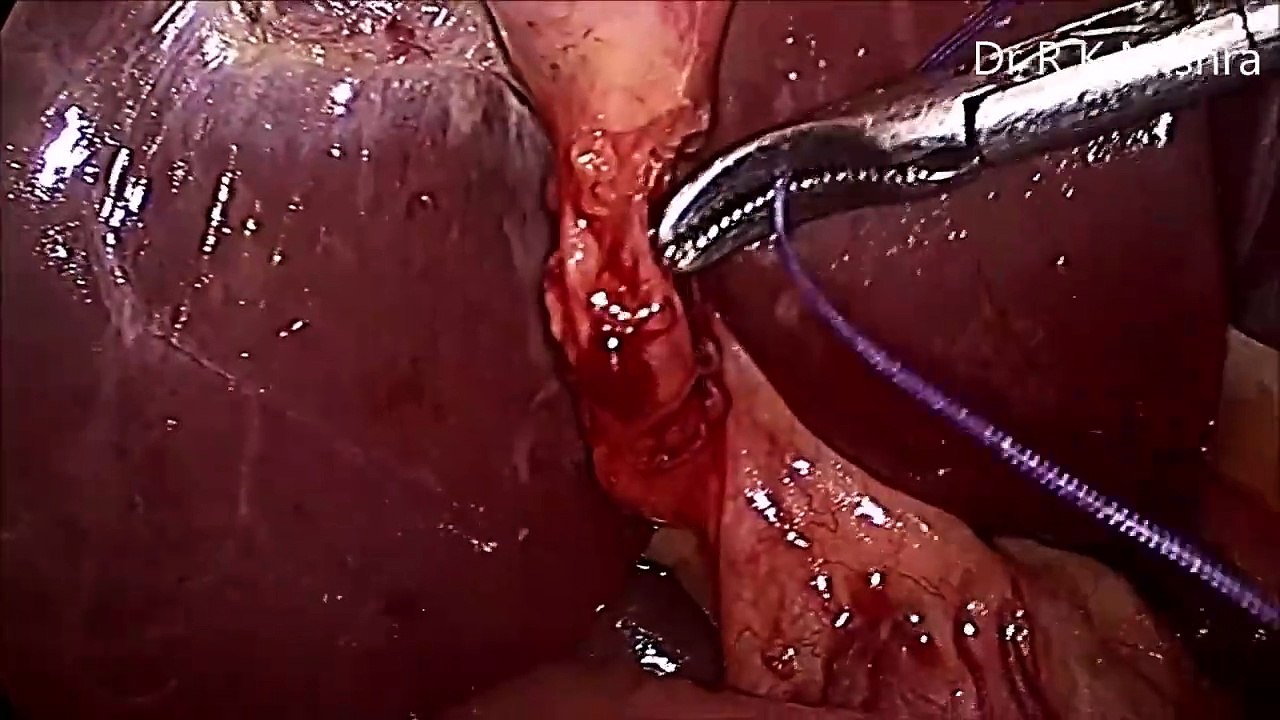 Laparoscopic Cholecystectomy with Laparoscopic Ovarian Drilling