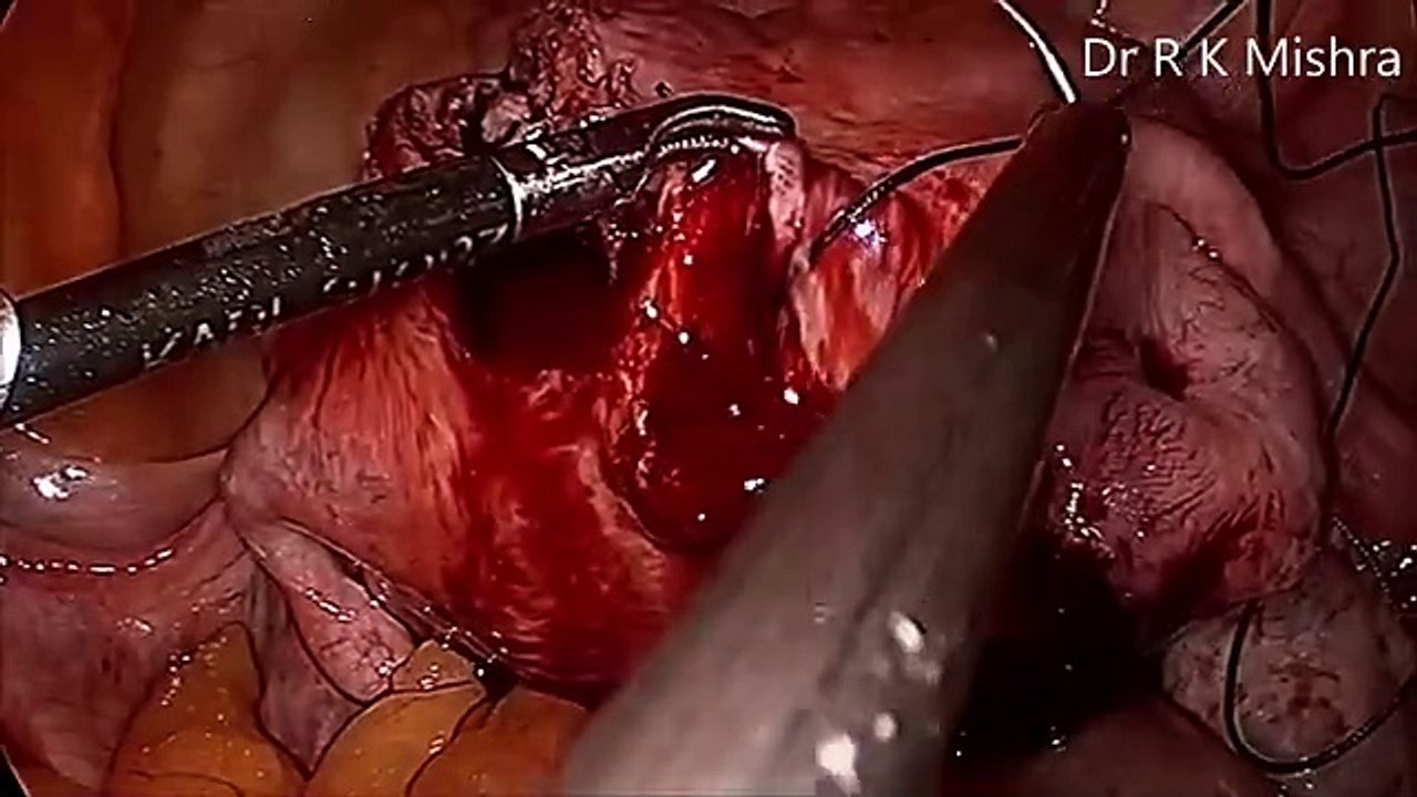 Laparoscopic Myomectomy for Multiple Myoma