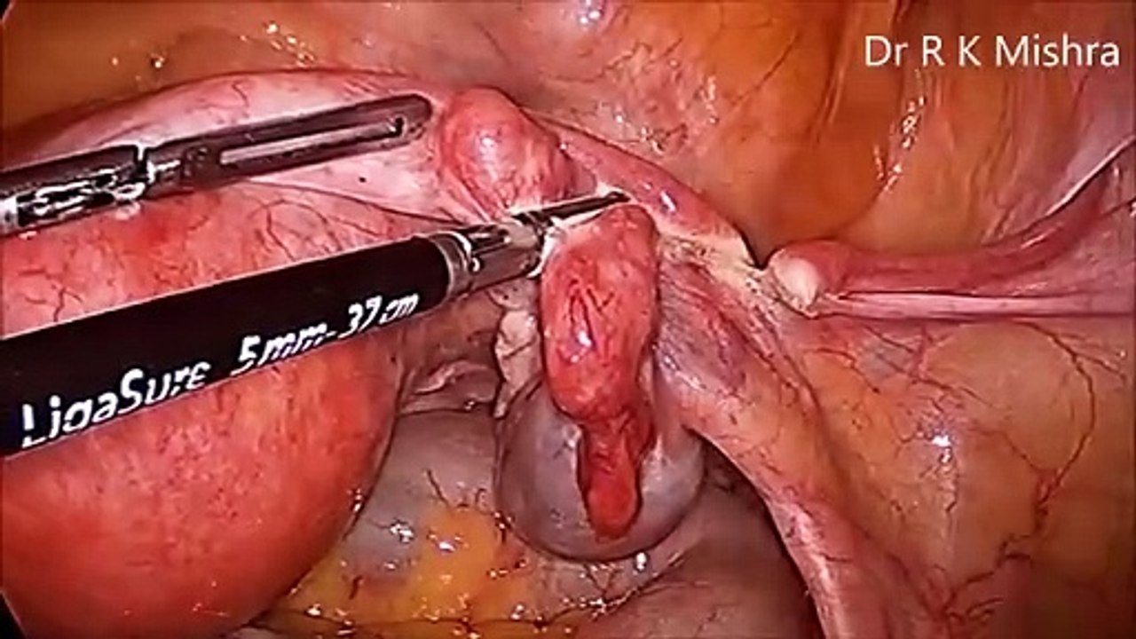Total Laparoscopic Hysterectomy with Bilateral Salpingo Oophorectomy
