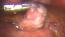 Lap Appendectomy in peritonitis