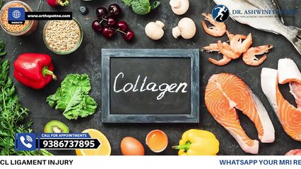 Diet After ACL Surgery _ ACL सर्जरी के बाद क्या खाएं और क्या नहीं_ - Dr Ashwini Gaurav In Patna