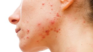 bd-acne-hormonal-causas-y-posibles-tratamientos-080524