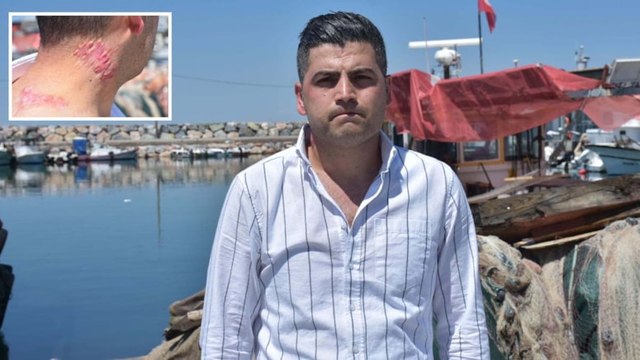 Lazer tedavisi sonrası 'yanık izi belirginleşti' suçlaması