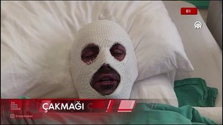 Erzurum'da gazı açık unutunca hastanelik oldu