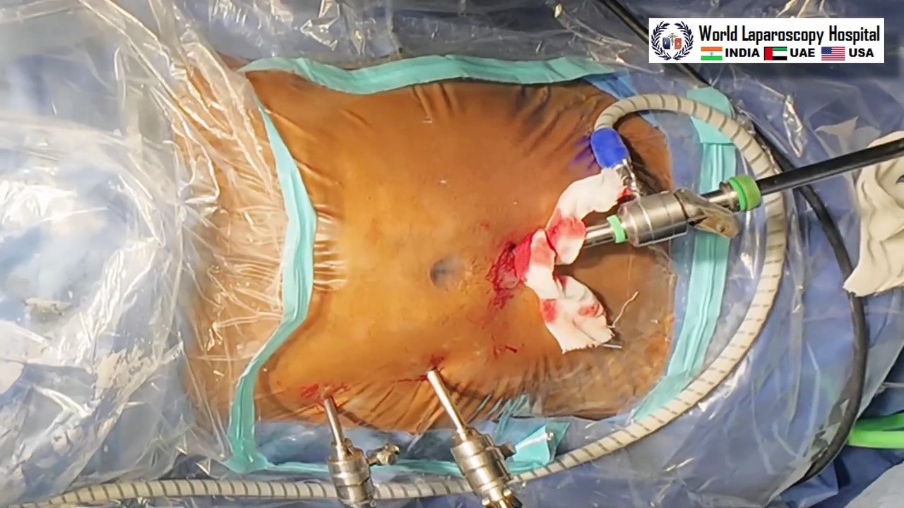 Laparoscopic Repair of Complete Inguinoscrotal Hernia Using TAPP Ipsilateral Port Technique