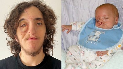 Mum told she was “cruel” for having her son after he was born with severe cleft lip