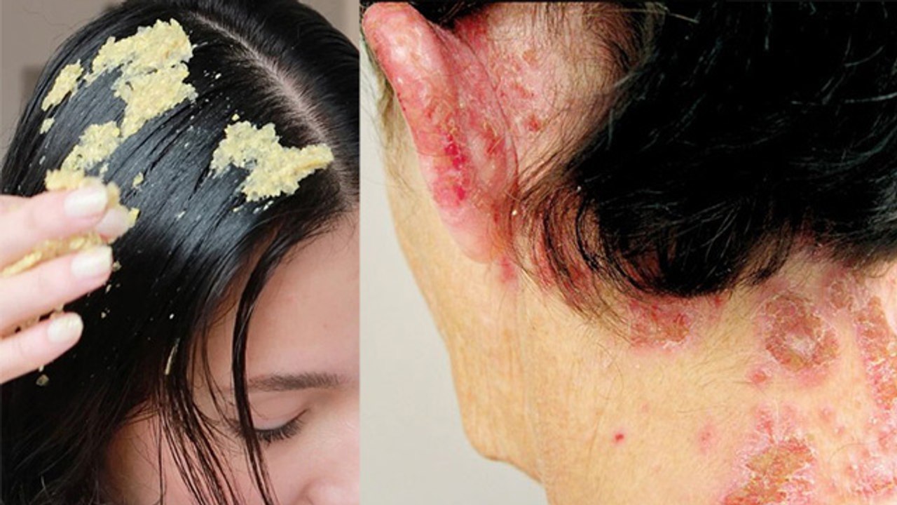 Balo Me Methi Lagane Ke Nuksan | बालों में मेथी लगाने के नुकसान | Boldsky