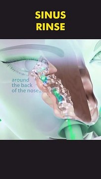 Sinus Rinse Procedure 3D Animation