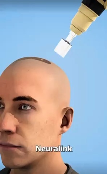 Neurolink Surgical Procedure