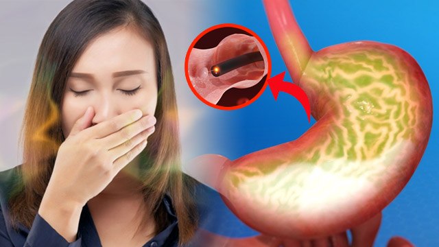 मुंह में खट्टा पानी आना, कारण और इलाज | Muh Me Khatta Pani Aana In Hindi | Boldsky