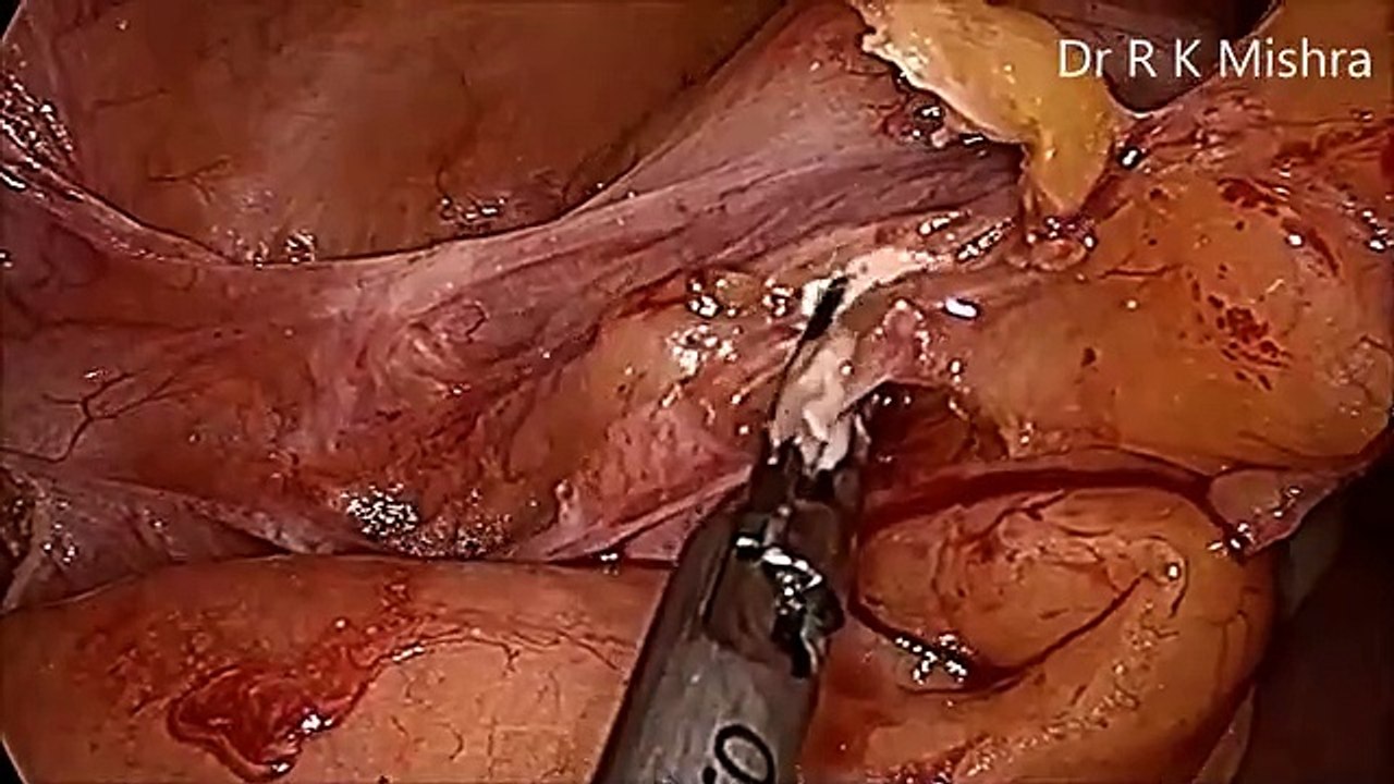 Laparoscopic Appendectomy for Fecalith of Appendix