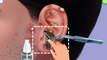 ASMRtreatment: Relaxing ear wax cleaning and tonsil stone removal for ultimate relaxation.